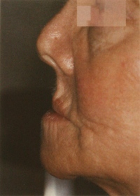 This patient has facial collapse