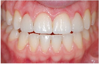An example of inflammed gums from porcelain veneers.