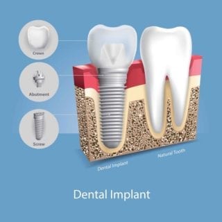 Graphic demonstration of the three elements of a dental implant